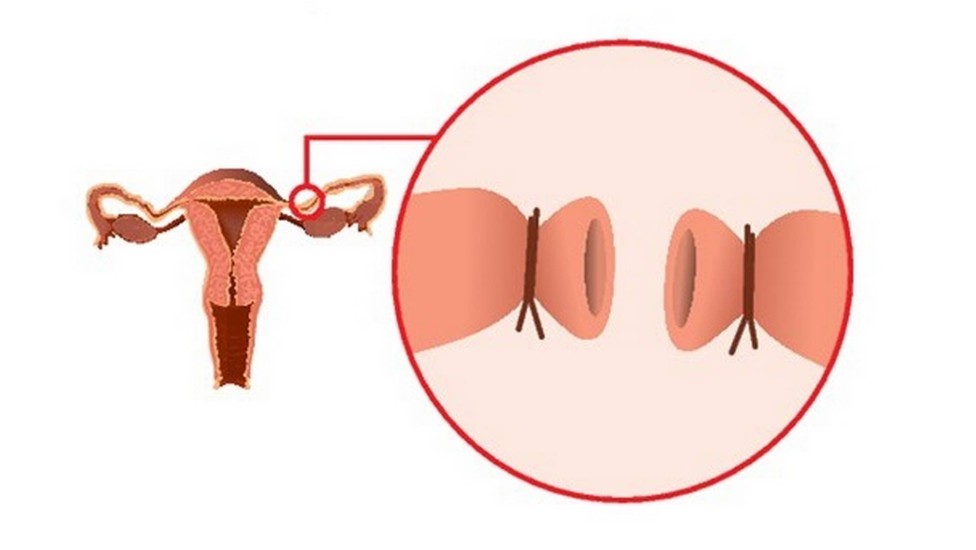 Plano de saúde cobre laqueadura