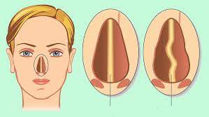 Plano de saúde cobre septoplastia?