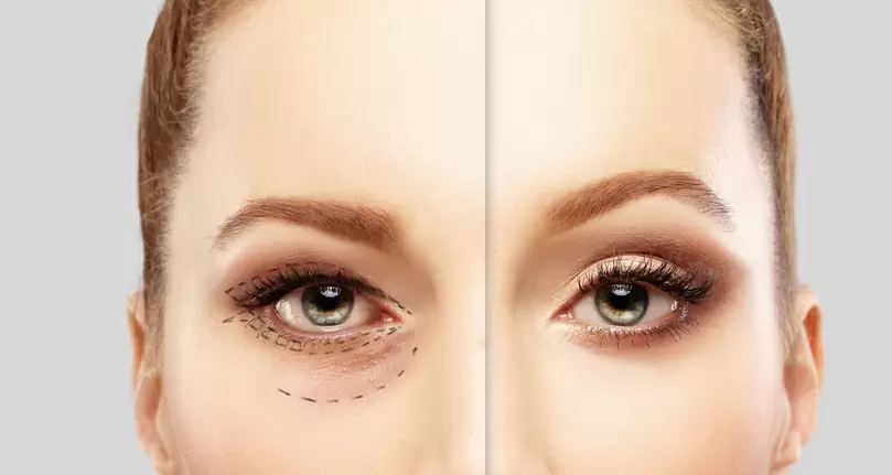 Plano de saúde cobre blefaroplastia