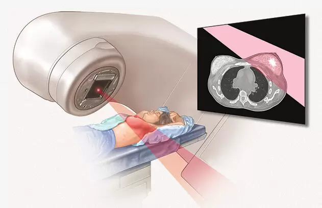 Plano de saúde cobre radioterapia?