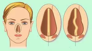 Plano de saúde cobre septoplastia?